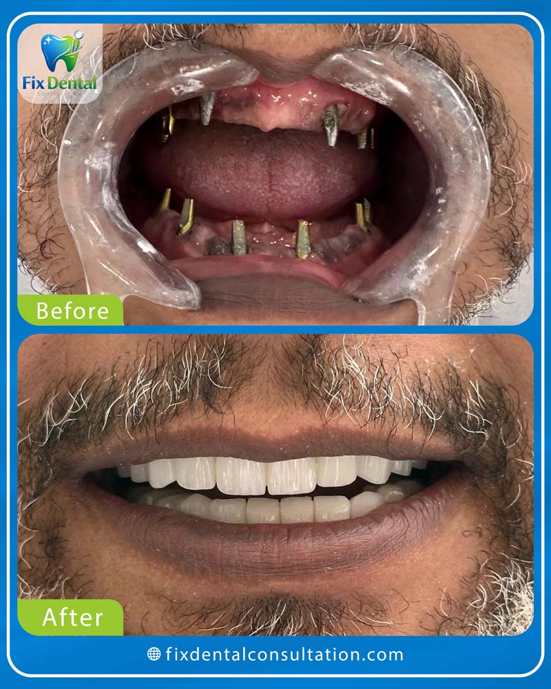 قبل وبعد - fix dental-1