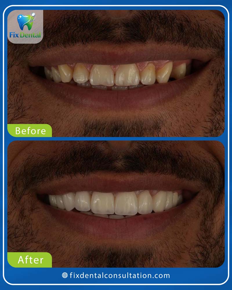 قبل وبعد - fix dental-2