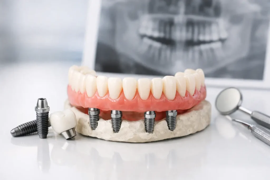 All-on-Four Guide for Full-Arch Dental Implants